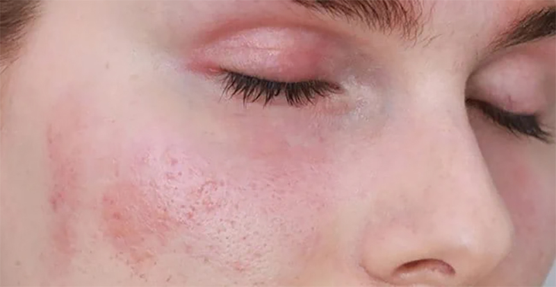 Da nhạy cảm (Sensitive Skin) và cách chăm sóc Da nhạy cảm